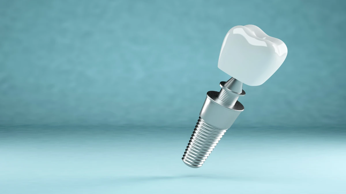 Dental Implants Procedure Wasilla, AK