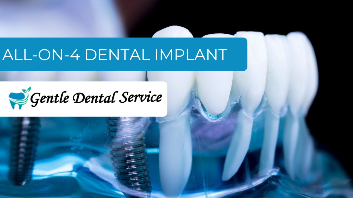 All-on-4® Dental Implants, Wasilla AK